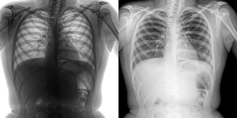 Chest Posteroanterior Projection X-Ray Showing Lung Structure and Disease Indicators for Accurate Diagnosis of Pulmonary Anthrax Isolated on Transparent Background