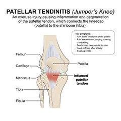 Patellar Tendinitis (Jumper&rsquo;s Knee) Flashcard