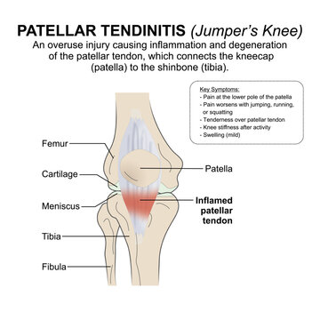 Patellar Tendinitis (Jumper&rsquo;s Knee) Flashcard