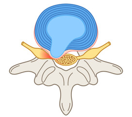 腰椎椎間板ヘルニア　椎間板の構造　腰痛