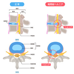 腰椎椎間板ヘルニア　椎間板の構造　腰痛