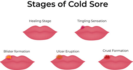 Cold Sore Progression A Visual Guide to Its Stages Vector Illustration