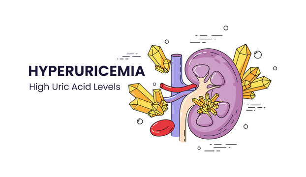 Hyperuricemia illustration with kidney and uric acid crystals concept.