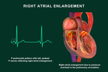 Right atrial enlargement with P-pulmonale, 3D illustration