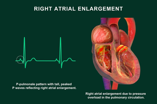 Right atrial enlargement with P-pulmonale, 3D illustration