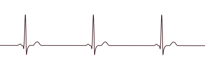 Sinus bradycardia, 3D illustration