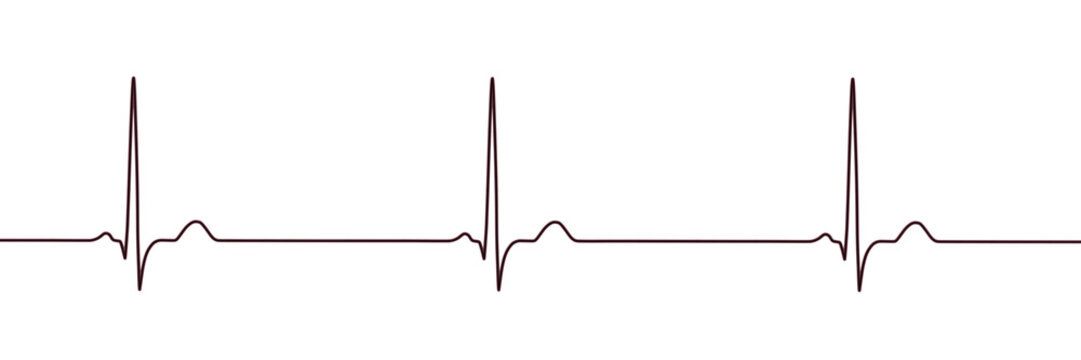 Sinus bradycardia, 3D illustration