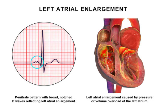 Left atrial dilation with P-mitrale, 3D illustration