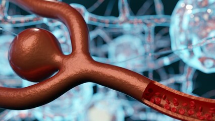 3D medical illustration of a brain aneurysm: a weak arterial wall bulges under pressure, creating a vulnerable point in the circulatory system.