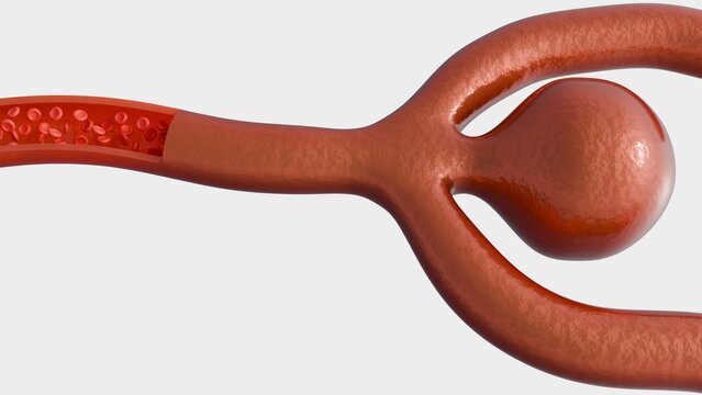 A 3d rendering of a cerebral aneurysm, illustrating the structural vulnerability of a blood vessel in the brain. A blood vessel or artery with a section cut away to show the interior flow.