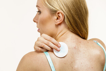 Woman acne on back cleaning skin with cotton