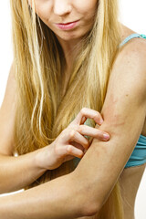 Woman scratching her itchy arm. Skin allergy.