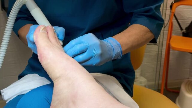 Hardware medical pedicure using a drill and nail files. A patient has a pedicure at a podiatrist. A dangerous fungal lesion of human toenails. Onychomycosis, treatment of nail fungus.