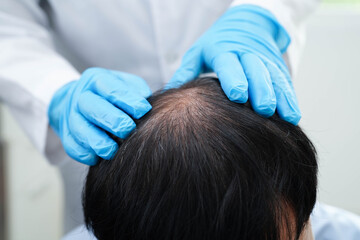 Doctor touch bold head in man, hair loss treatment health problem.