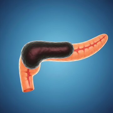 Pancreatic Adenocarcinoma growth visualized as a dark, irregular mass on the head of the pancreas, full organ view, high-detail medical illustration, volumetric lighting, blue gradient background,