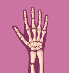 X-ray Revealing Fracture of the Hand Bones Vector Illustration. Person after suffering an accident having fractured bones 
