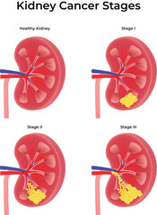 Kidney Cancer Stages Progression Diagram Vector Illustration