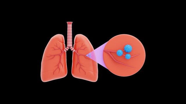 3D Diagram of lung cancer | Alpha Channel