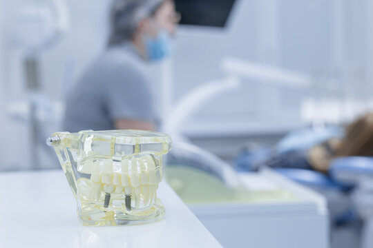 Dental implant jaw model on clinic desk during patient consultation in modern dentistry