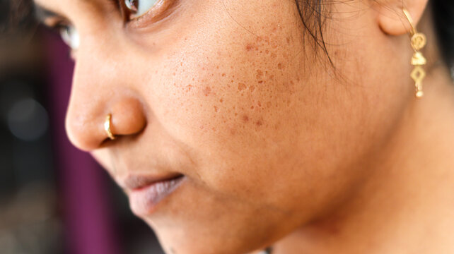 Close-up side profile of Indian woman's face showing real skin texture with acne scars, open pores, and blemishes. Concept of dermatology, skincare problems, and natural beauty.