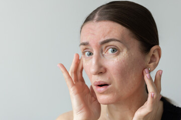 Woman shocked how looks her face after biorevitalization. 
