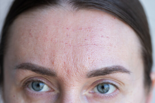Female forehead after beauty injections. Woman with problem skin and wrinkles just made facial beauty injections.