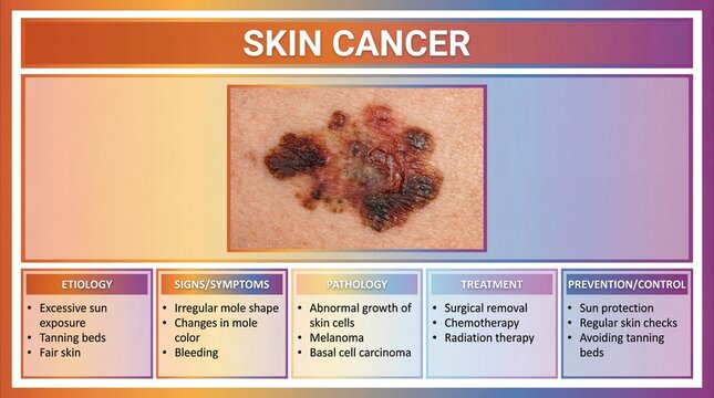 Skin cancer information with symptoms and treatment options for melanoma and basal cell carcinoma
