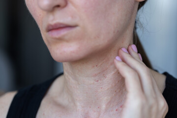 Female neck after biorevitalization procedure. Closeup. Beauty injections.