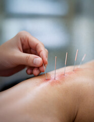 Close up of therapist hand inserting acupuncture needles into patient back skin for traditional chinese or contemporary medicine treatment and holistic pain relief therapy