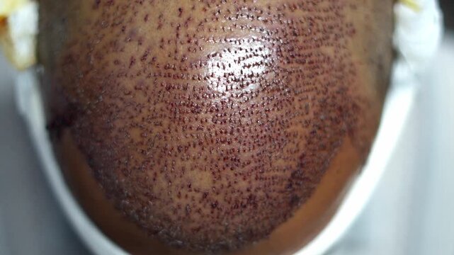 Detailed close-up of hair transplant on crown area, highlighting implanted follicles, scalp texture, and early stage hair restoration healing.