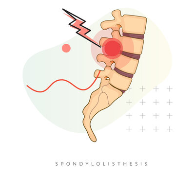 Spondylolisthesis grade 1- Spinal Joints - Stock Illustration