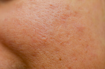 Fototapeta premium Dermatology Concept: High-Detail View of Human Skin Surface with Freckles, Pores, and a Raised Mole