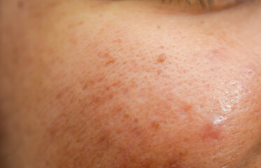 Fototapeta premium Macro Texture of Human Skin: Close-up of Cheek and Nose with Visible Pores, Freckles, and a Small Mole