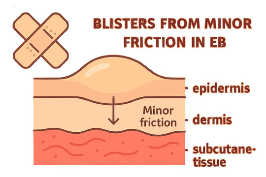 Epidermolysis Bullosa Fragile Skin Blisters Illustration
