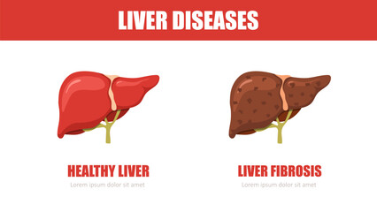 Liver disease. Healthy and fibrosis liver. Internal organ icons. Medical illustration. Vector design.
