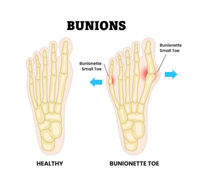 Healthy and bunion and bunionette as feet bone disorder condition. hallux valgus deformation disease. Big toe and foot connected joint. Medical education poster flat vector illustration.