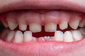 A child's smile with a gap between teeth, caused by lost front baby teeth. Dental development highlights the importance of oral health.