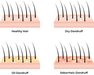 Scalp Conditions Healthy Hair Dry Oily and Seborrheic Dandruff Comparison vector illustration