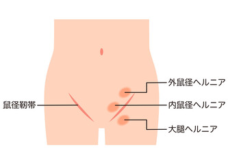 鼠径ヘルニアの種類　ヘルニア　股関節