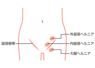鼠径ヘルニアの種類　ヘルニア　股関節