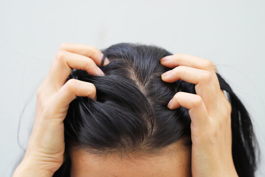 A woman has problems with hair and scalp,she has dandruff from allergic reactions to shampoos. and hair conditioner	
