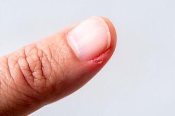Human fingernail with redness and minor wound around the cuticle, showing nail infection, hangnail irritation, or paronychia. Medical health concept, skin problem detail. macrophoto