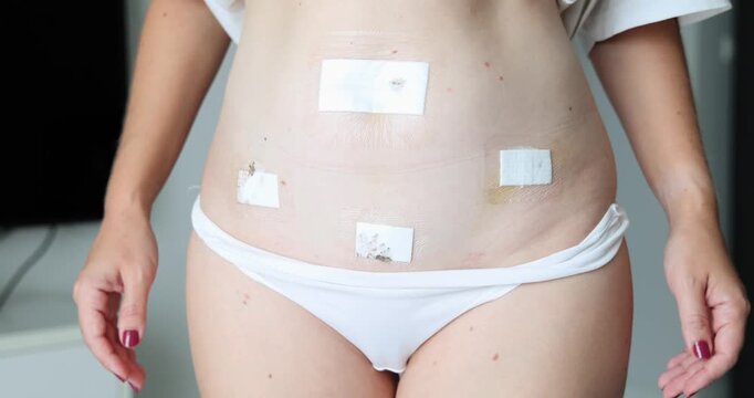 Woman's abdomen displays multiple small surgical bandages after laparoscopic surgery. Post-operative recovery, healthcare, and medical procedure concept. Close-up.