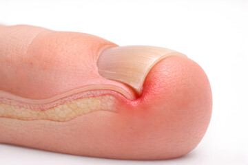Fototapeta premium Photorealistic 3D macro close-up of an ingrown toenail on the big toe, nail edge curving into the lateral nail fold with mild swelling and redness, intact skin, ultra-detailed skin pores and cuticle t