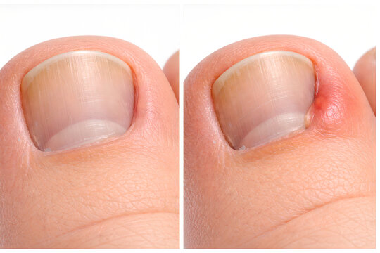 Photorealistic 3D macro close-up of an ingrown toenail on the big toe, nail edge curving into the lateral nail fold with mild swelling and redness, intact skin, ultra-detailed skin pores and cuticle t