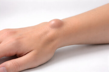 Photorealistic 3D macro close-up of a dorsal wrist ganglion cyst, smooth rounded subcutaneous bump on the back of the wrist near the scapholunate region