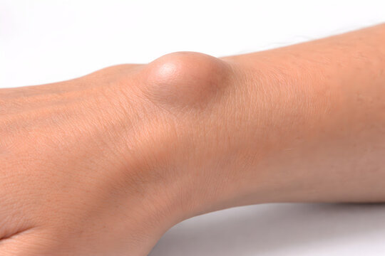 Photorealistic 3D macro close-up of a dorsal wrist ganglion cyst, smooth rounded subcutaneous bump on the back of the wrist near the scapholunate region