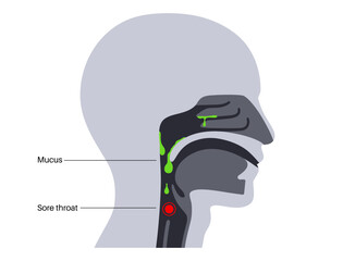 Postnasal drip poster