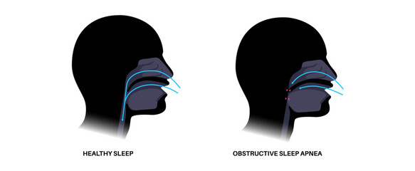 Obstructive sleep apnea