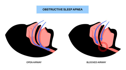 Obstructive sleep apnea